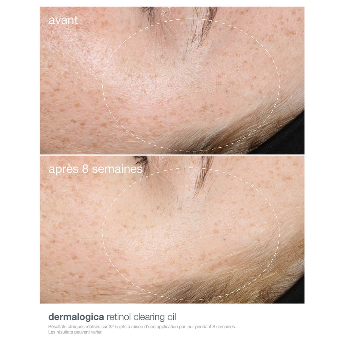 Dermalogica Retinol Clearing Oil - Anti-Aging Night Oil with Salicylic Acid for Acne and Skin Renewal
